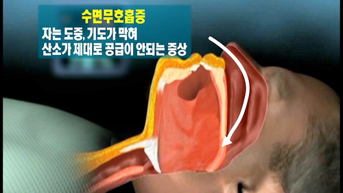 코골다 사망?! 수면무호흡증이란 | MBC 연예 스포츠