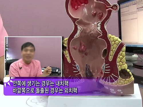 찬바람이 불면 괴롭다! 여성들의 은밀한 고민 ‘치질’ 이미지-4