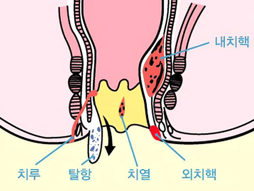 찬바람이 불면 괴롭다! 여성들의 은밀한 고민 ‘치질’ 이미지-2