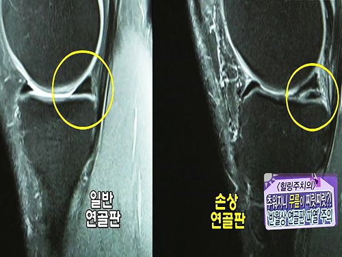 추워지니 무릎이 찌릿? 찌릿! 이미지-6