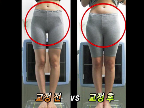 http://enews.imbc.com/News/RetrieveNewsInfo/87645 먹을 거 다 먹고 20kg 감량! 골반 교정하면 살이 빠져? | MBC 연예 스포츠