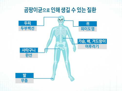 잠 못 이루는 가려움 몸에 핀 곰팡이 제거법 이미지-5