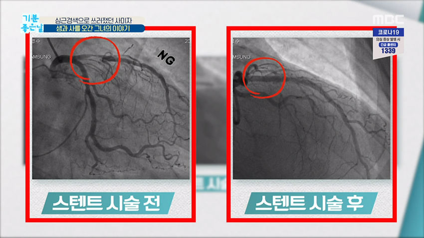 심장 혈관 수술 스텐트 시술 방법 전격 공개 4086