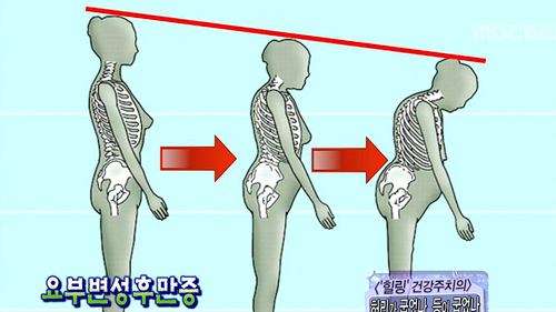 40대도 꼬부랑 할머니처럼? 요부변성후만증