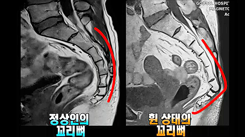 지긋지긋 허리통증, 꼬리뼈 때문?