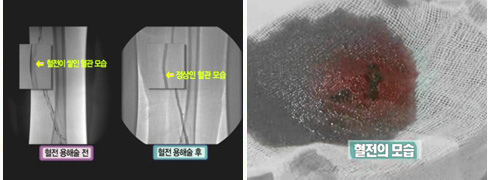 [심부정맥 혈전증] 다리 부종이 쉽게 가라앉지 않는다면?