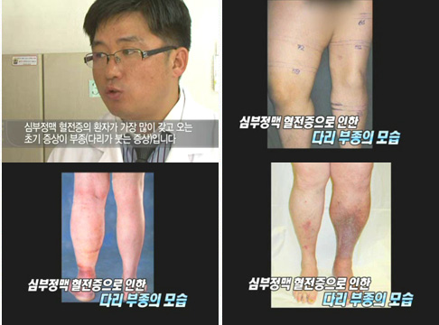 [심부정맥 혈전증] 다리 부종이 쉽게 가라앉지 않는다면?