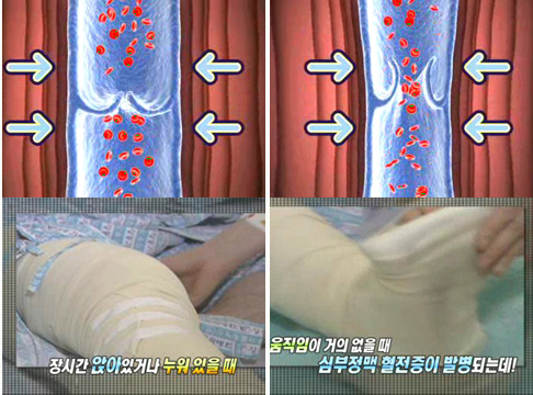 [심부정맥 혈전증] 다리 부종이 쉽게 가라앉지 않는다면?