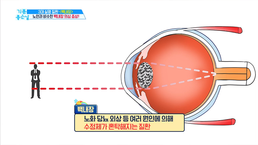 백내장 증상, 노안으로 착각해서 방치하면 어떤 결과가?