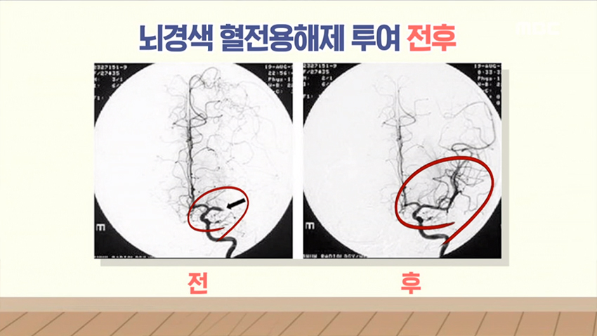 ※돌발퀴즈※ 진득진득한 피! 뇌혈관 막으면?