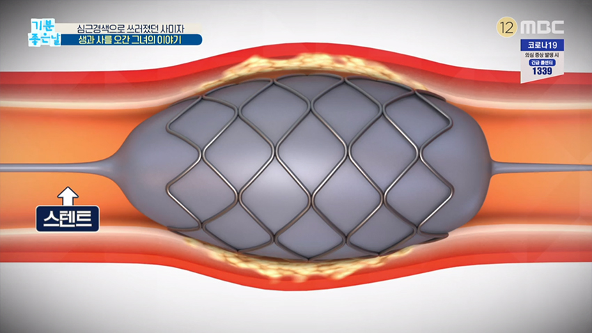 심장 혈관 수술 스텐트 시술 방법 전격 공개 3959