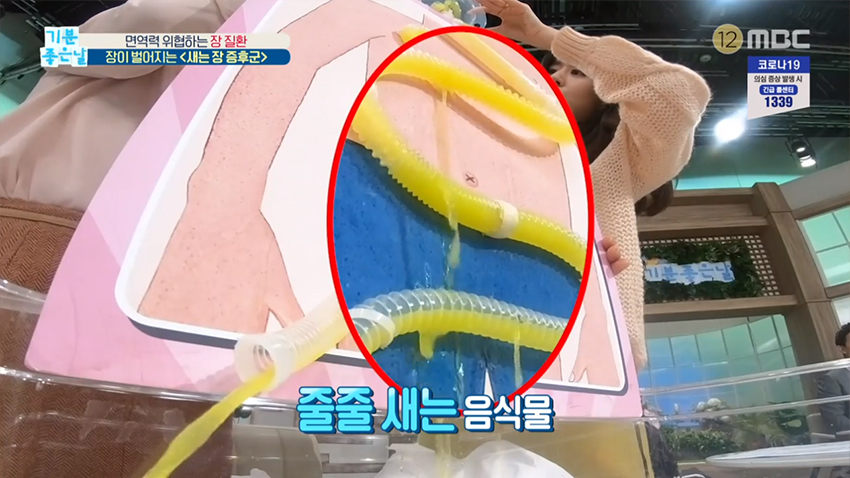 면역력 위협하는 장 질환, 장이 벌어지는 ＜새는 장 증후군＞