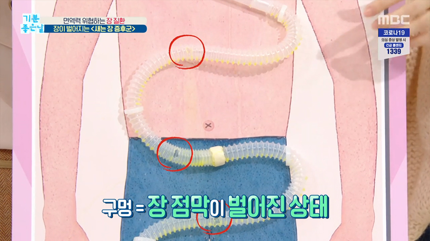 면역력 위협하는 장 질환, 장이 벌어지는 ＜새는 장 증후군＞
