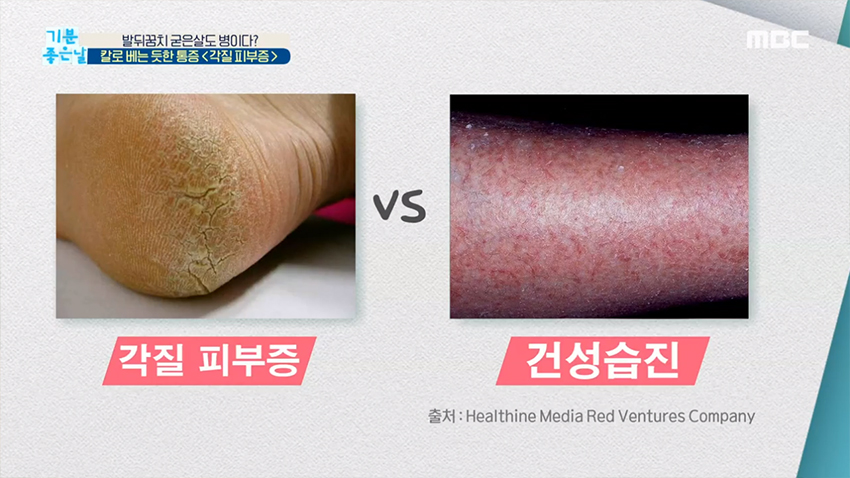 칼로 베는 듯한 통증 <각질 피부증>