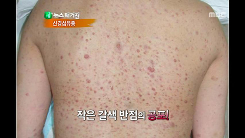 삶을 망가트리는 갈색반점, 신경섬유종